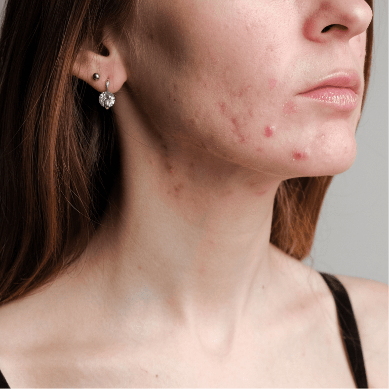 Hormonal Acne And Its Impact On Adolescent Confidence